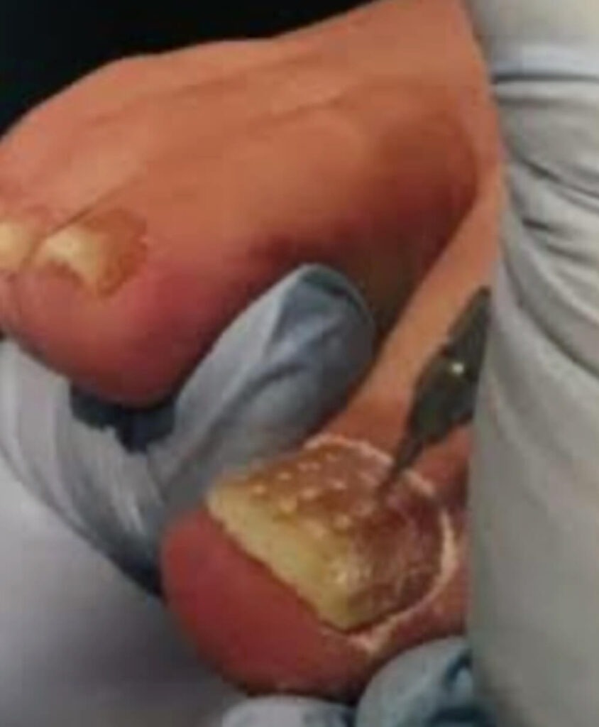 Fungal nail treatment